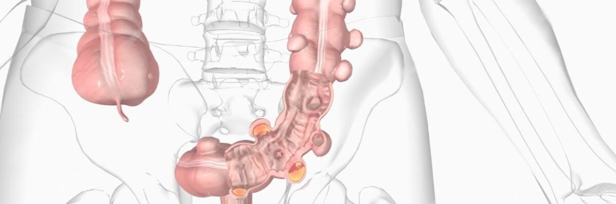 Diverticulitis